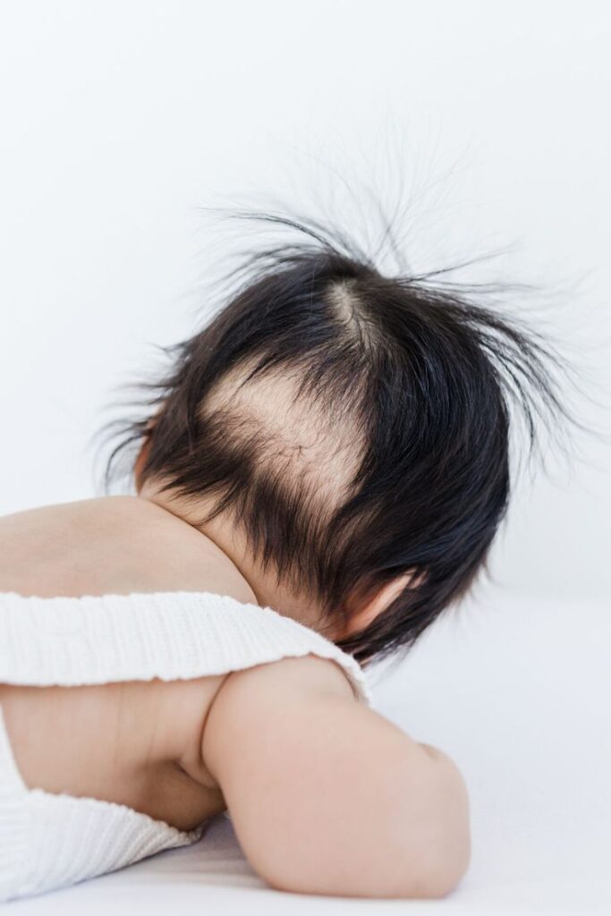 Close-up of a baby lying face down showing a bald patch at the crown surrounded by dark hair, illustrating the natural hair loss pattern babies often go through in their first few months."