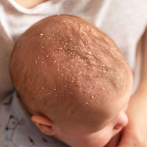 Cradle cap on a babys hair