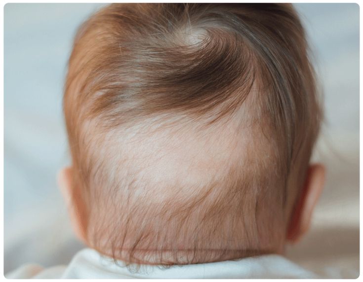 Back view of a baby's head showing a hair swirl at the crown with thinner hair around it, typical of newborn hair before it fully fills in."