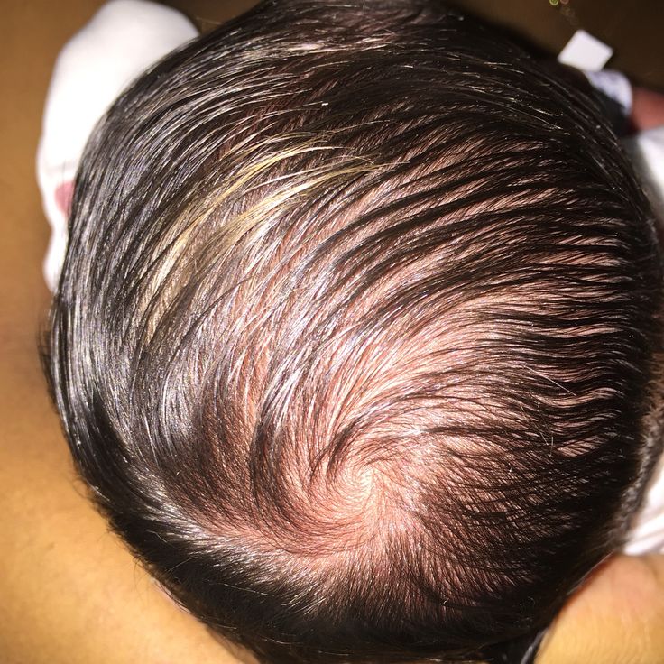 Overhead close-up of a baby's scalp showing a natural hair swirl at the crown, with dark hair growing in different directions across the head."
