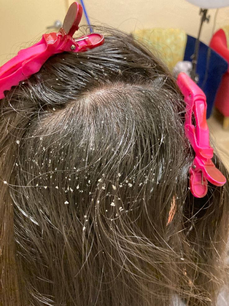Dandruff and flaking on a kids hair