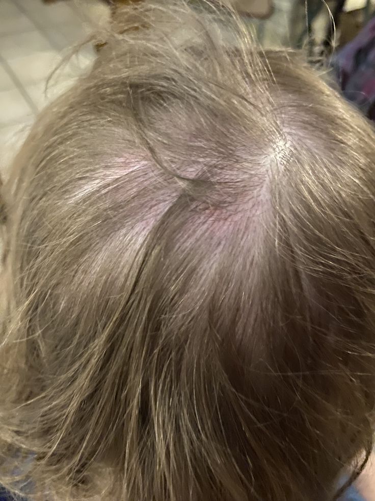 A young toddler with a little temporary red patch on the hair