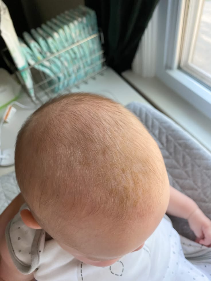 Close-up of a baby's scalp showing cradle cap patches